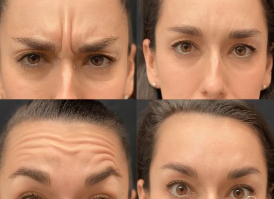 Wrinkle Treatment