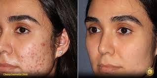 Chemical Peeling After