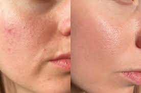 Glow Treatment After