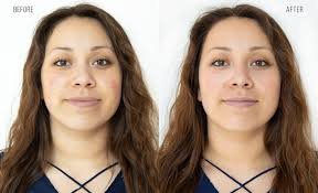HydraFacial Skin Glow