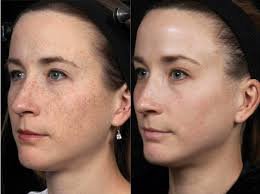 Laser Facial Glow