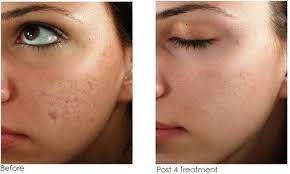 Microneedling After