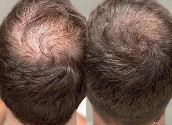 Alopecia Treatment