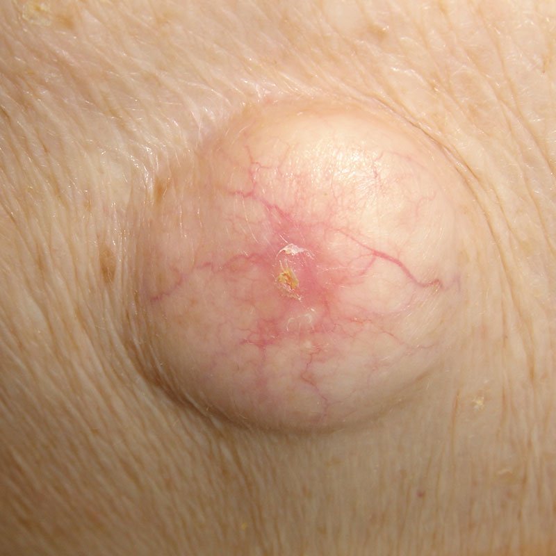 Alopecia Treatment