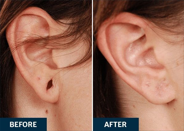 Dandruff Treatment