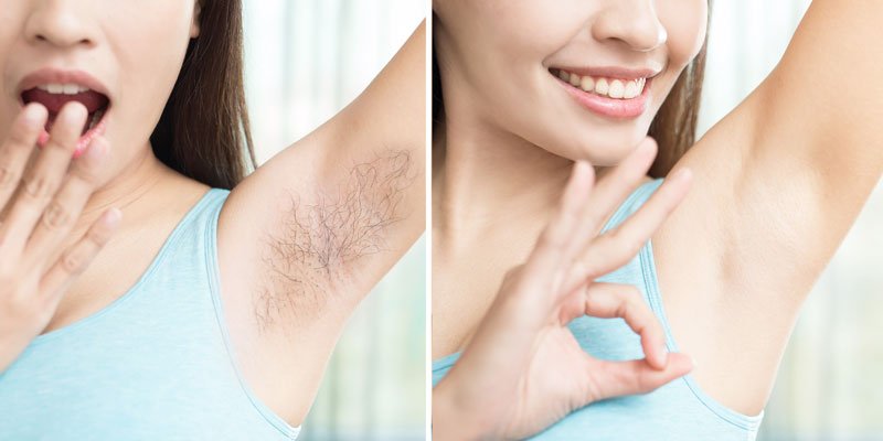 Laser Hair Removal All Skin Types