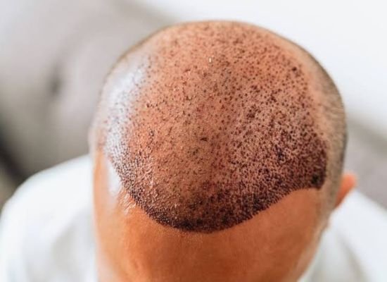 Dandruff Treatment