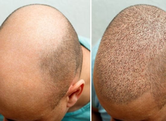 Alopecia Treatment