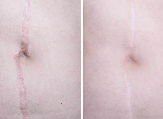 Alopecia Treatment