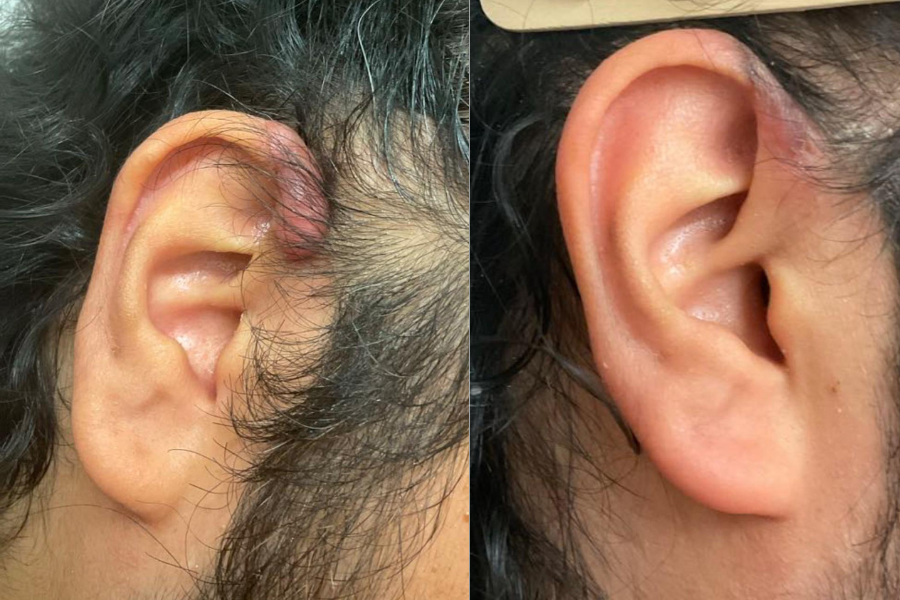 Alopecia Treatment