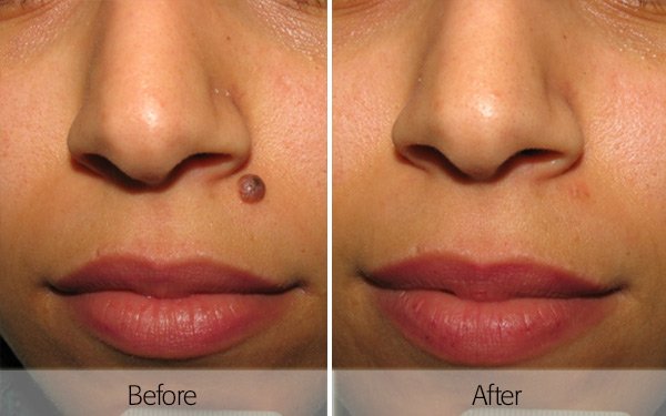 Alopecia Treatment