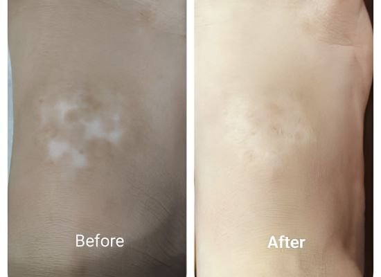 Dandruff Treatment