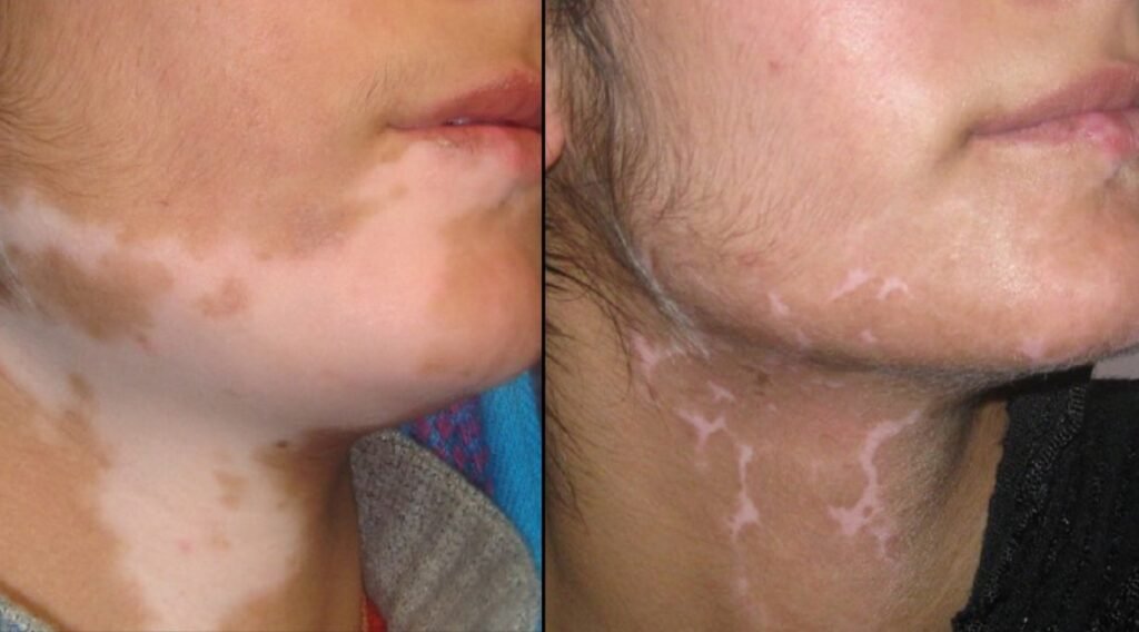 Alopecia Treatment