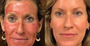 Vampire Facial Glow